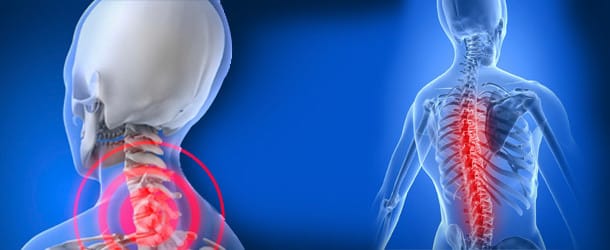 остеохондроз